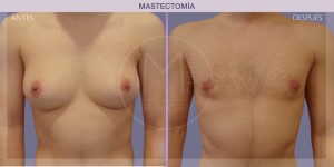 Before and after pictures of a mastectomy procedure (top surgery)